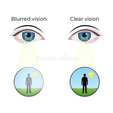 An educational illustration showing blurred vision through an eye.