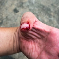 A minor cut on a finger being treated with first aid