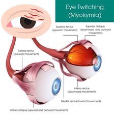 A simple illustration of an involuntary facial twitch