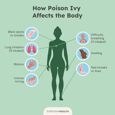 A medical illustration showing a red rash caused by poison ivy