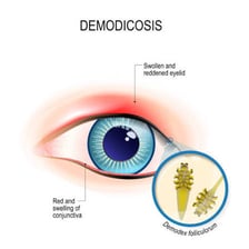 A medical illustration showing a stye on the edge of an eyelid.