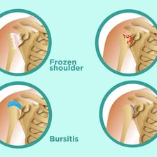 A person rubbing a sore shoulder to indicate a dull ache.