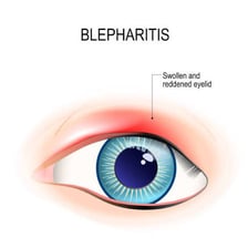 A medical illustration showing a stye on an eyelid