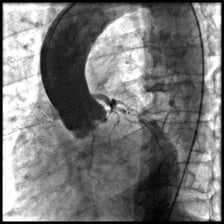 A medical angiogram showing the aorta and major blood vessels.