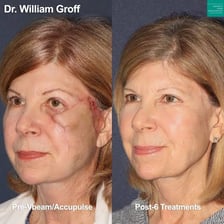 A dermatologist using a laser device for scar treatment