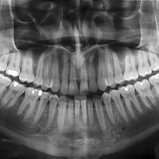 A radiographic image showing a person’s teeth