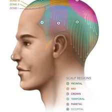 An illustration indicating the crown of the head