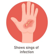 Medical illustration showing bacteria associated with an infected wound