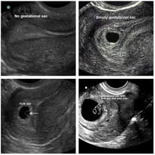 An ultrasound image of a uterus on a medical monitor.