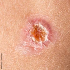 A scab forming over a healing skin wound.