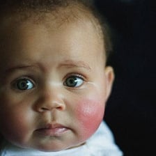 A close-up showing rosy, flushed cheeks