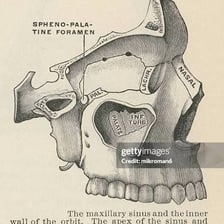 A medical illustration showing the sinus cavities within a human skull