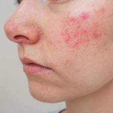 A face shows uneven red patches associated with exposure to cold.