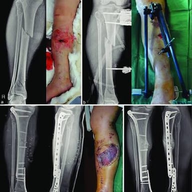 An X-ray showing a fracture in a human leg bone
