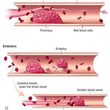 Medical illustration of blood forming a clot inside a blood vessel.