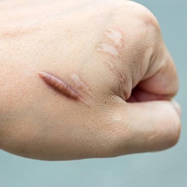 A healed scar on human skin