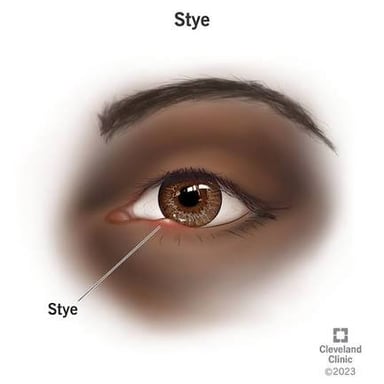 A medical illustration showing a small stye near the eyelashes.