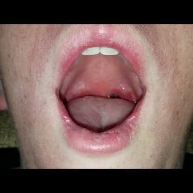 A medical professional examining a patient’s open mouth.