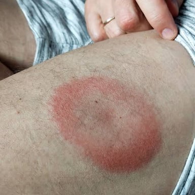 A small raised mark on skin, illustrating a welt.
