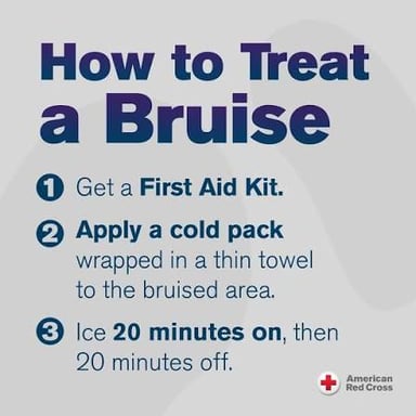 A cloth-wrapped ice pack being held gently against a bruised area.