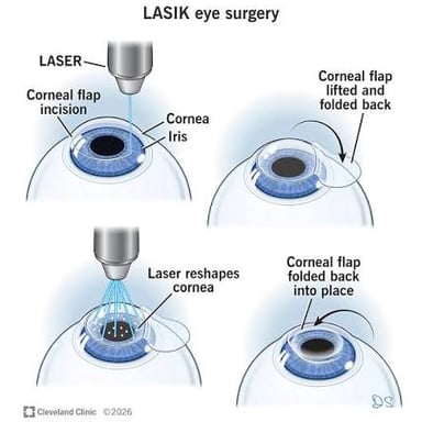 Medical diagram showing a corneal flap and laser reshaping during LASIK surgery