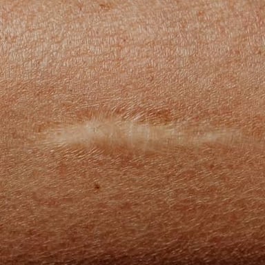 A close-up of a healed scar on skin