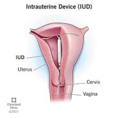 A medical illustration showing an intrauterine device inside the uterus.