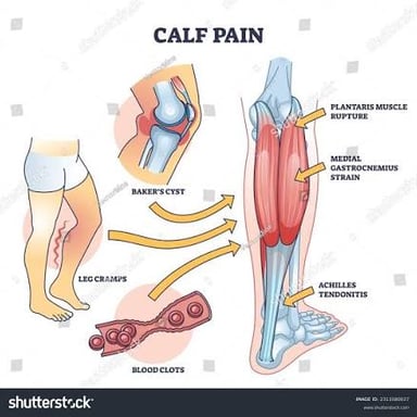 An illustration showing a cramp in a leg muscle.