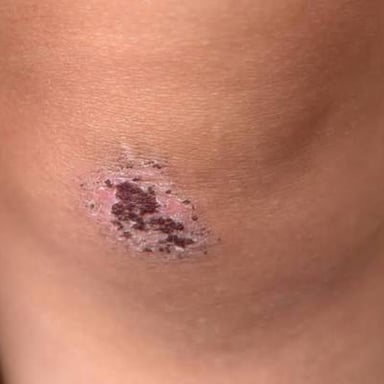 A small scab forming over a skin scrape.