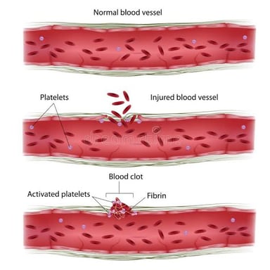 A simple medical illustration showing a blood clot forming in a blood vessel.
