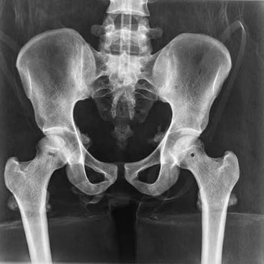 A medical X-ray showing the bones inside a human body.